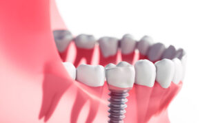 Close-up of a dental implant integrated into the lower jaw, illustrating the implant's placement and its realistic appearance alongside natural teeth.