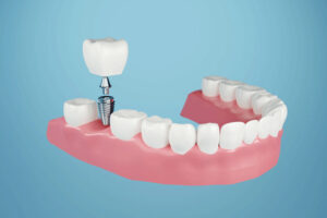 Dental implant, Fixing missing teeth with metal screw, teeth crown treatment 3D rendering